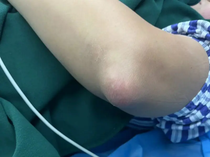 痛风患者如何规范服用碳酸氢钠片？
