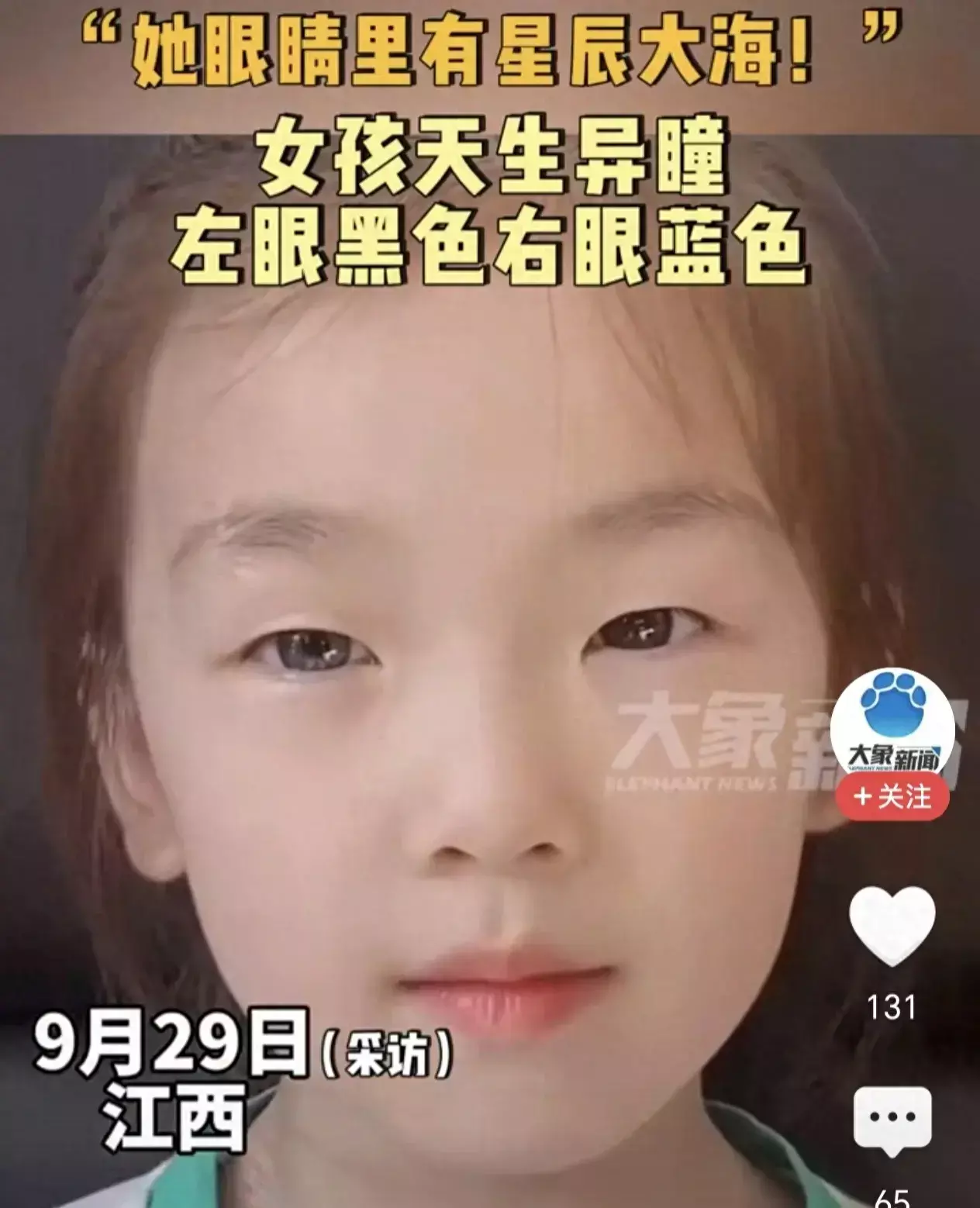 江西女孩天生左眼黑右眼蓝，医生：正常！网友：羡慕嫉妒恨