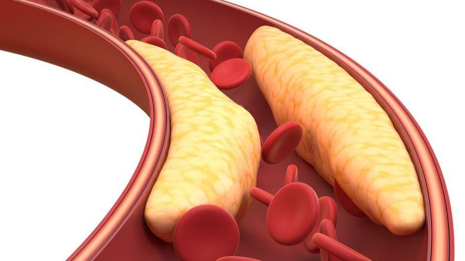 血脂高的人少吃肉、多吃素就能降血脂？未必！做好3件事才是关键