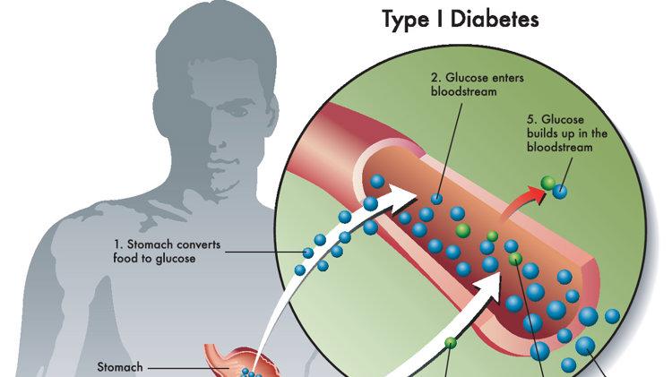 糖尿病与长寿关系被发现，英国研究：50岁患糖尿病，寿命缩短11年