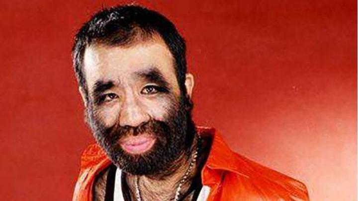 当年轰动一时的“毛孩”：42岁娶90后娇妻，生下一子未遗传长毛