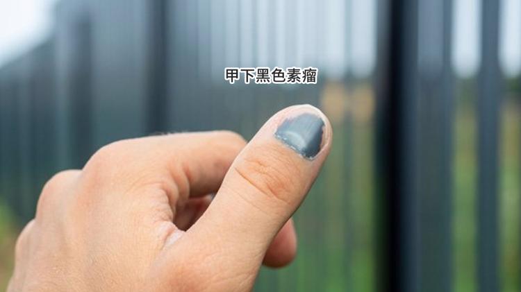 提醒：指甲若长成4种样子，可能是癌或疾病的信号，请留心观察