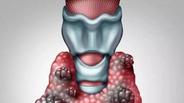 患者问：甲状腺癌手术后出现癌转移的淋巴结怎么办？