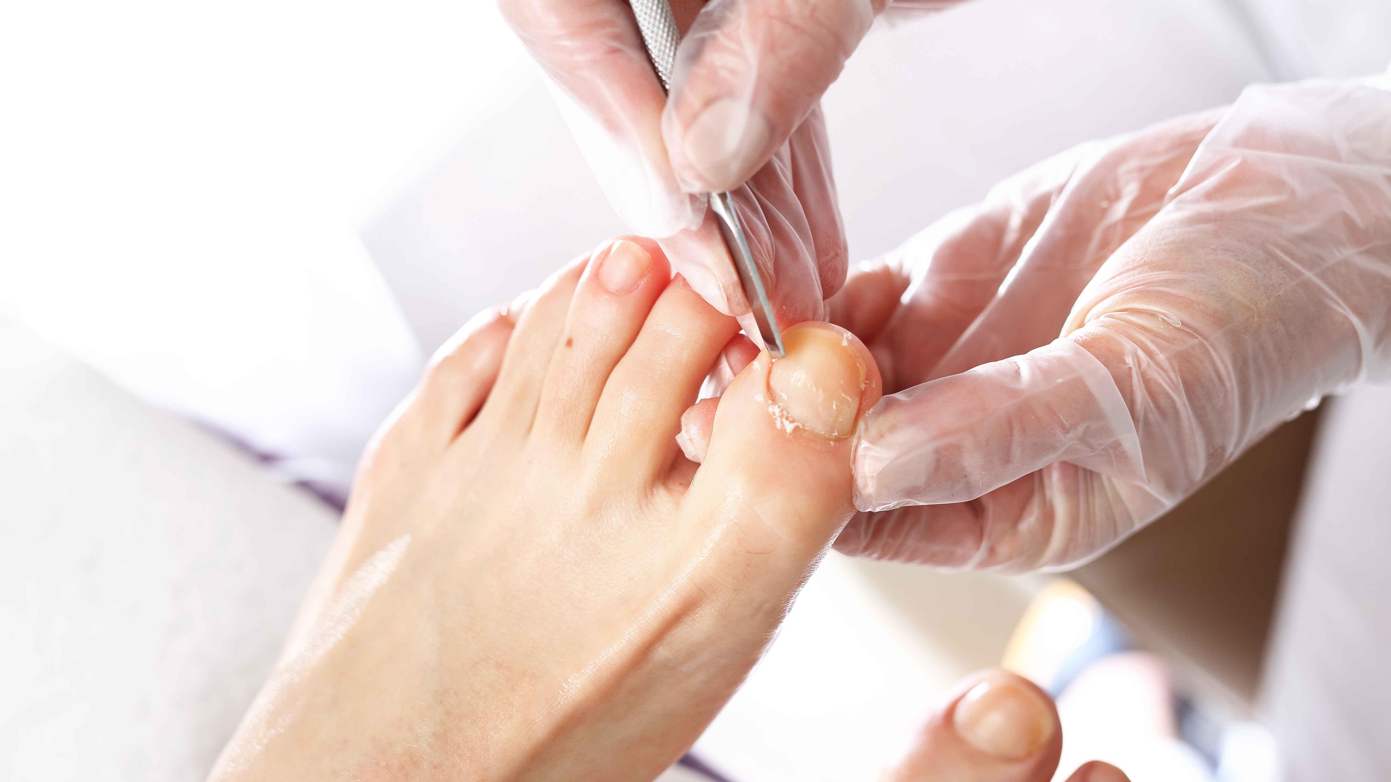 脚趾甲长进肉里，疼痛难忍？一文带你了解它，早干预少受罪！