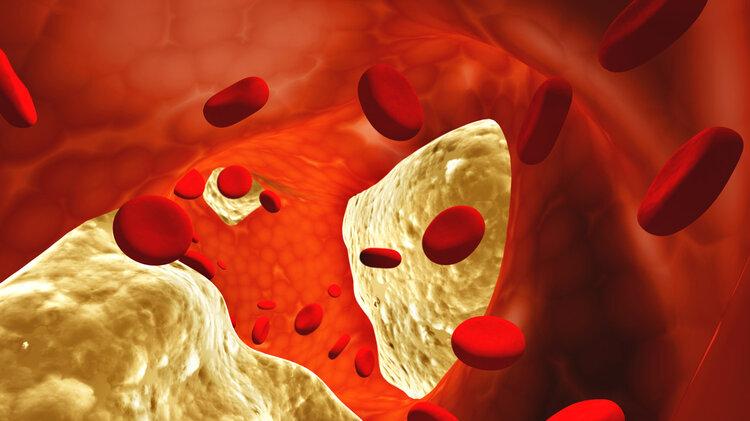 科学家发现：动脉粥样斑块竟能完全消退！不过要满足4个条件
