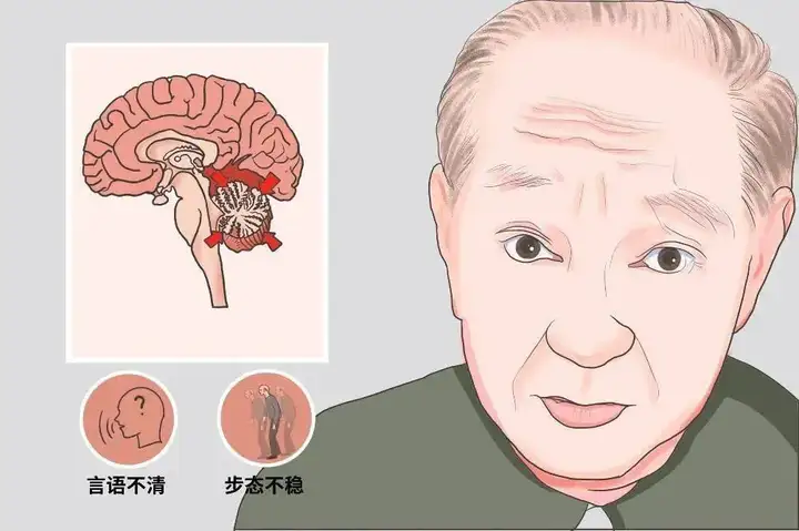 注意！引发脑梗的这些高危习惯可能你也有