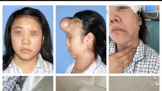 《15年隐痛：女子整形后体内现金属异物，鉴定不利维权陷困境》