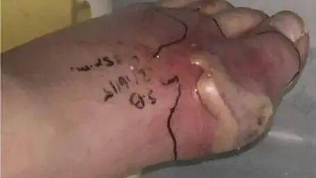 痛风石破了流“白石灰”？急诊方案错了恐截肢！速看微创取石专家的4步正确处置法