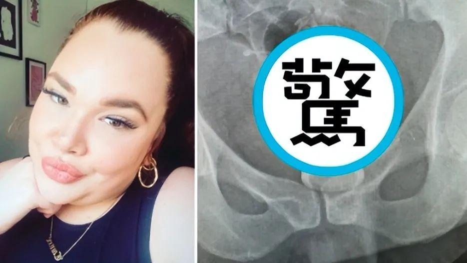 英国离婚女，深夜摆弄成人玩具出事故， 5名男医生研究半小时才弄出来