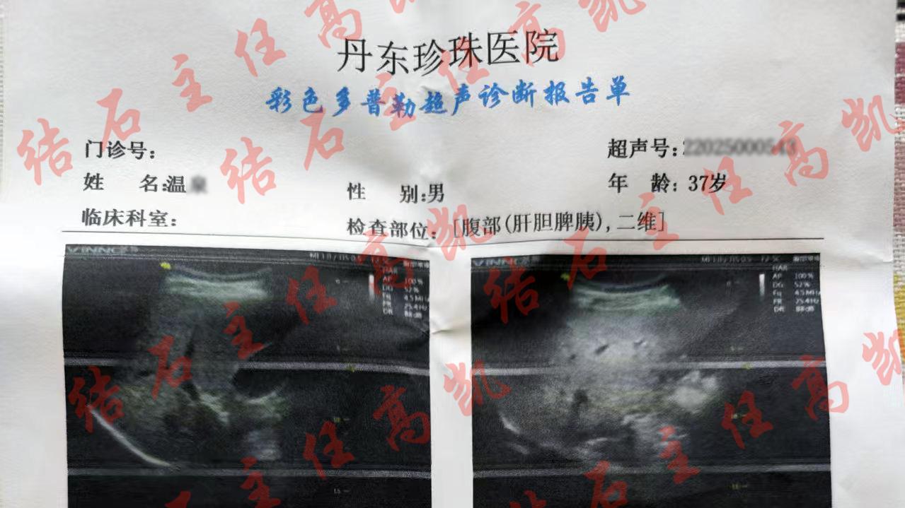 胆结石胆囊壁结石化小