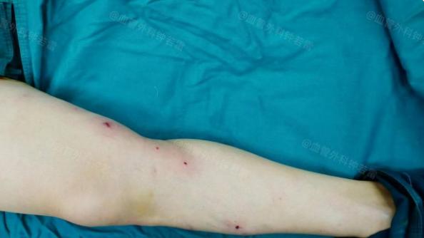 60岁，朋友介绍做了静脉曲张微创，要不是亲自经历，真会觉得像做梦一样