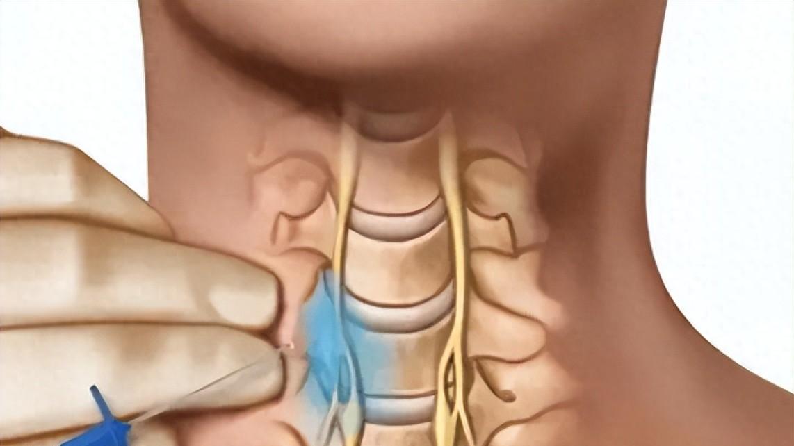 揭秘SGB疗法：“打针”就能解决睡不着的难题？