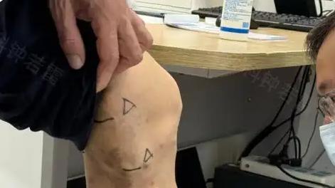 3次治静脉曲张：从打针剧痛到手术复发，65岁找钟主任做微创，终于不遭罪了