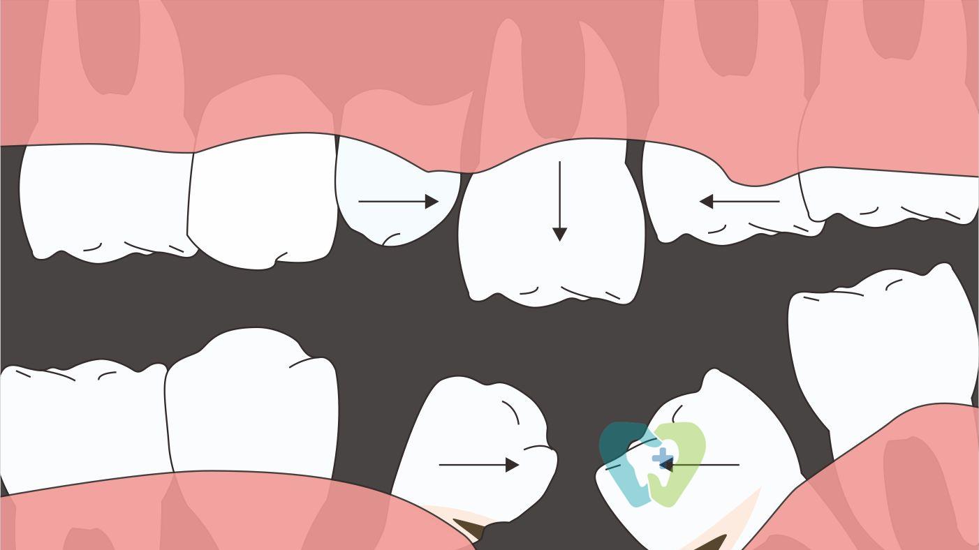 拔牙后多久种牙最好？这份时间表请收好