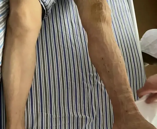 收藏！关于静脉曲张手术后，你不得不知道的事儿~