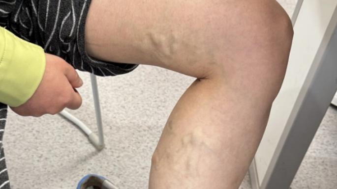 打硬化剂治静脉曲张并非“万能”，盲目选择只会得不偿失