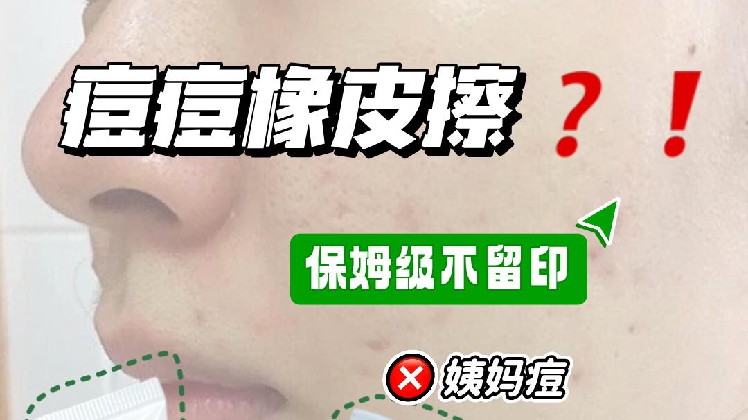 青春期护肤指南|冒痘、脸泛油？3 个护理要点，帮他找回自信笑脸