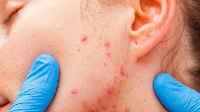 脸上很多痘，异维A酸软胶囊要固定吃半年吗？