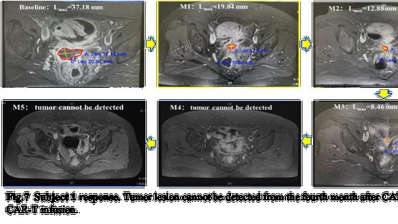 “我多活了数月，高质量地活着”！CAR-T疗法临床试验正在招募，为卵巢癌患者赢得高质量时光