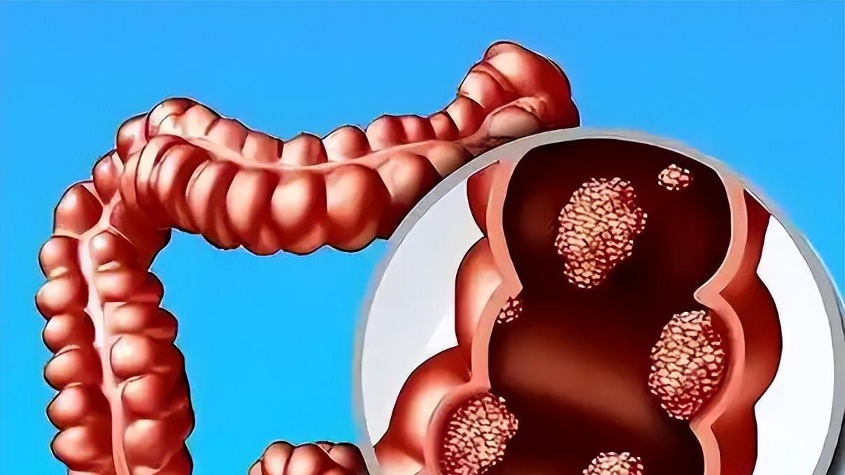 30岁后，便血不一定是痔疮，也可能是直肠癌，4类高危人群易患病