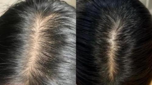 2025最好的防脱生发液产品，激活休眠毛囊，绒毛碎发炸出来