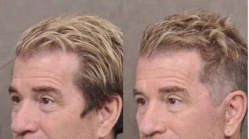 996卷成002后，硅谷科技男为不被裁员扎堆做医美……