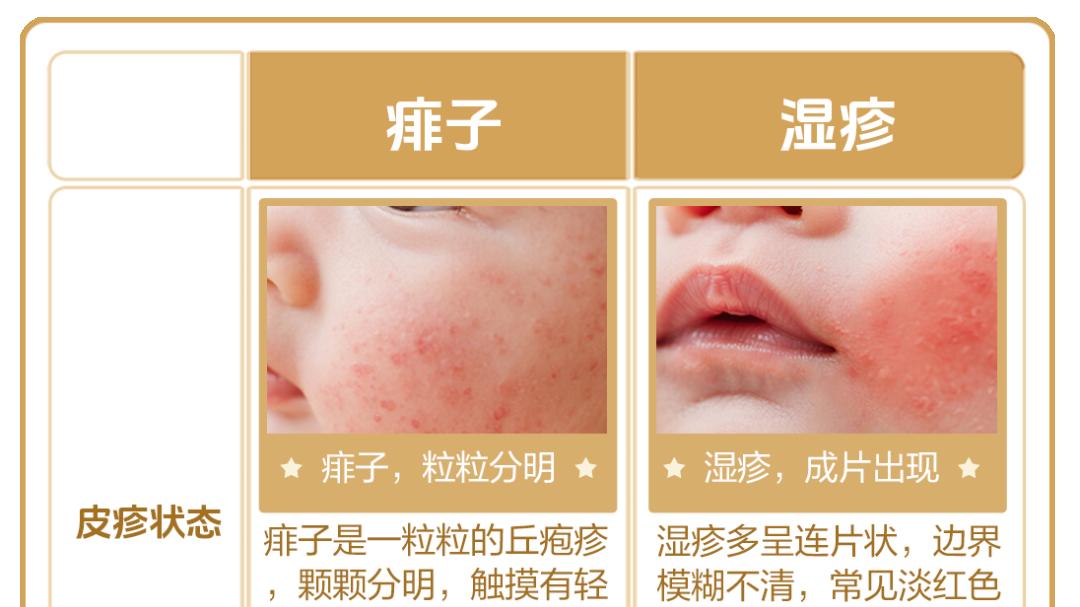 痱子VS湿疹分不清？4招教你分清护理误区！