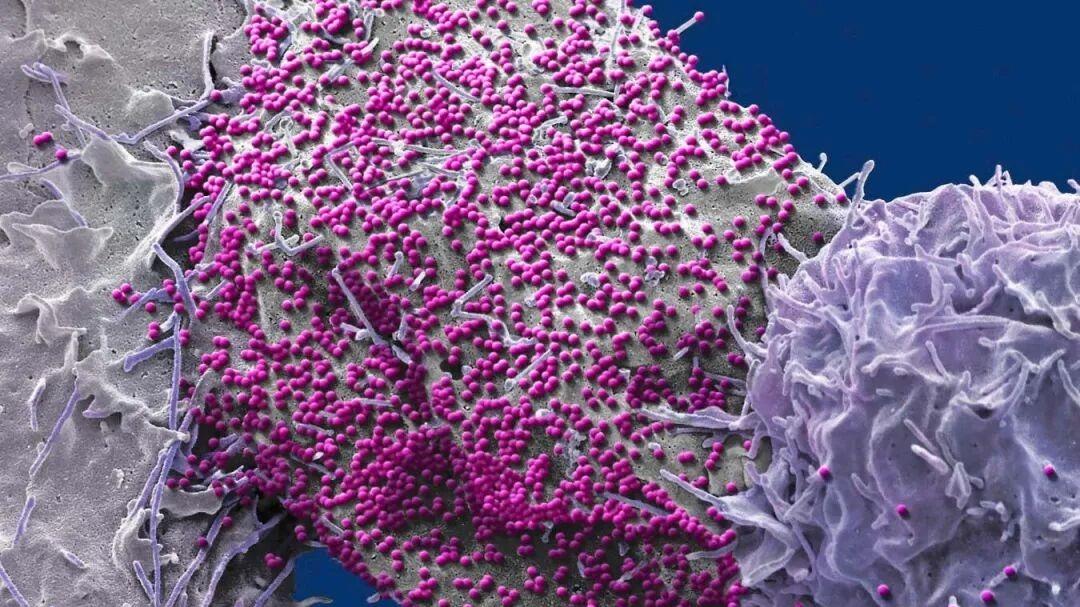 最新研究显示：干细胞移植治愈HIV的关键并不依赖“CCR5基因突变”，普通干细胞也可做到