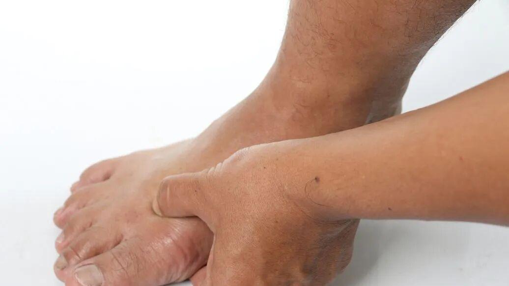 高尿酸多久会形成关节结晶？3个科学方法，溶解结晶不残留！