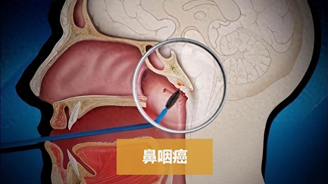 你以为是鼻炎？小心鼻咽癌，4类人群易患病，早期治疗生存率超90%