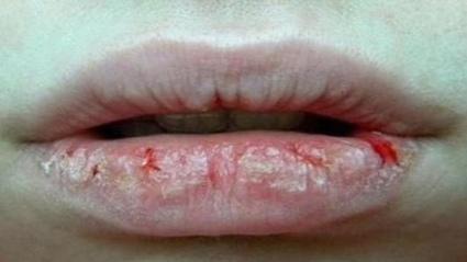 《你也可以优雅健康地生活》第二章，治疗嘴唇干裂的食疗方子