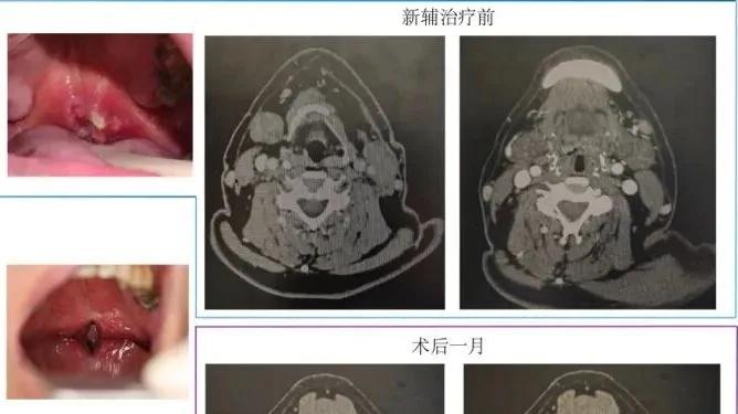 全机器人手术实现口咽癌治疗新突破！