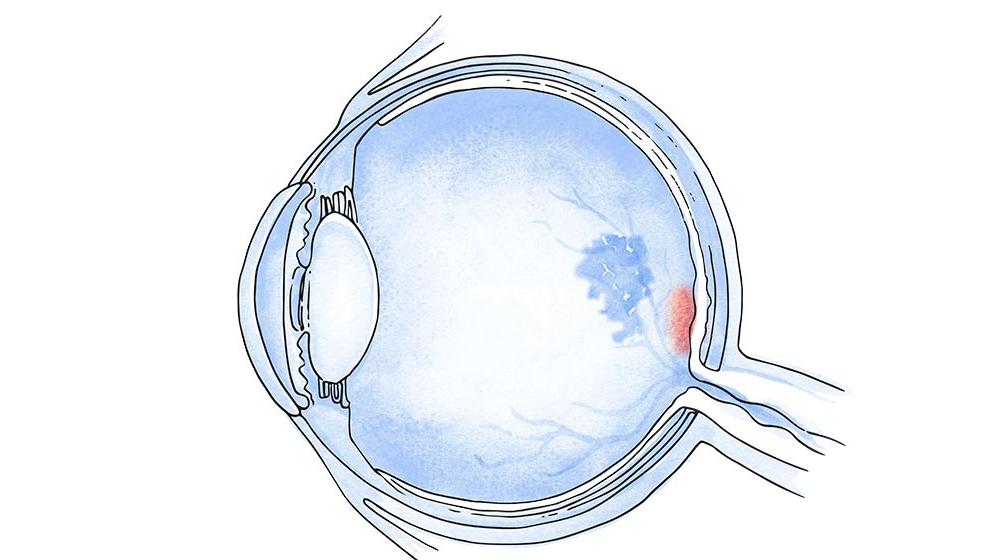 全球首款！Tinlarebant三期试验成功，少年黄斑变性现曙光