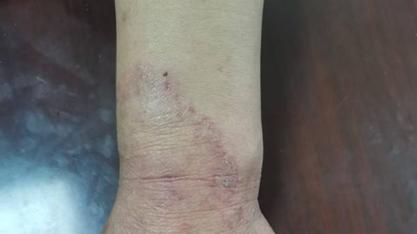 大部分HIV感染者都“中招”的隐秘“入侵者”：皮肤真菌