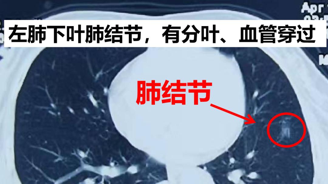 肺结节肺癌这么多，是不晒太阳惹的祸？！