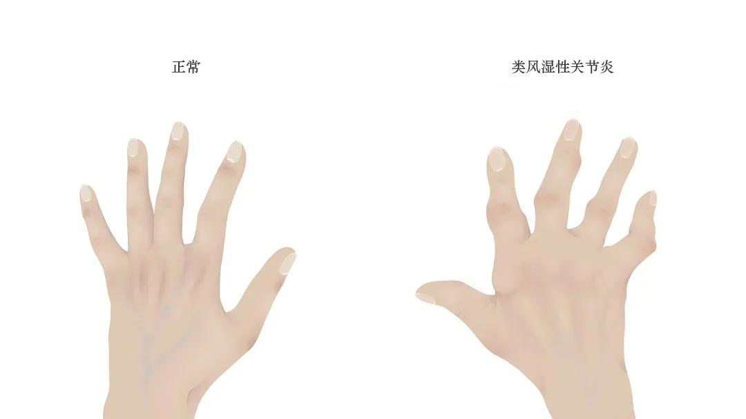 抗风湿药物KEVZARA重要安全信息：可能出现的副作用及如何应对