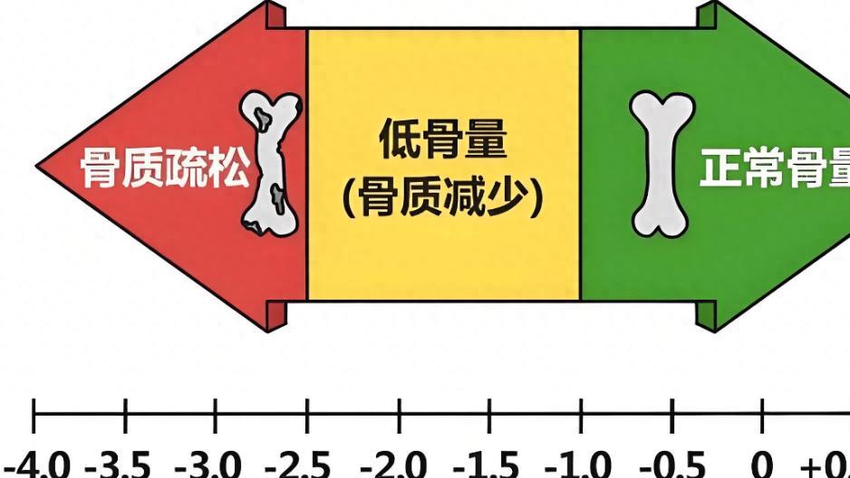 提高骨密度的3个中成药：仙灵骨葆胶囊，金天格胶囊，骨疏康胶囊