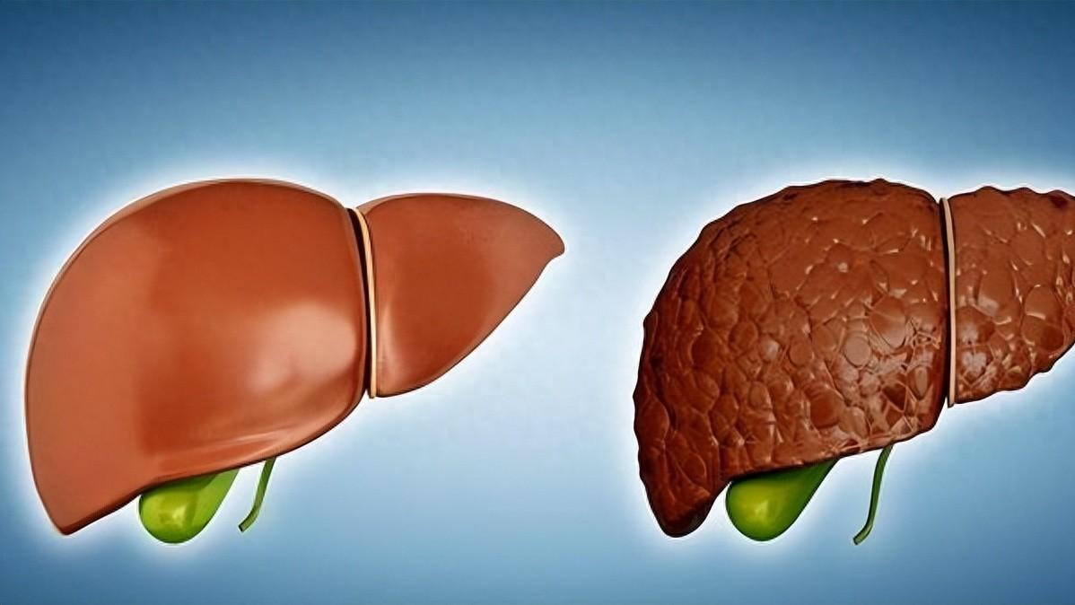 乏力、食欲减退、腹胀别当小毛病，小心肝硬化，10个习惯最易患病