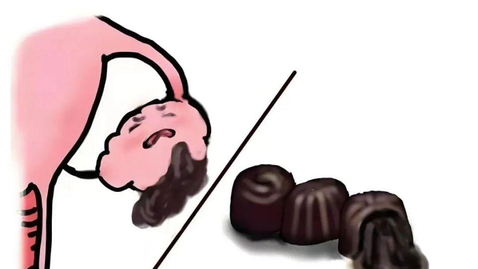 昆明送子鸟;卵巢巧克力囊肿有什么征兆？囊肿是怎么形成的？