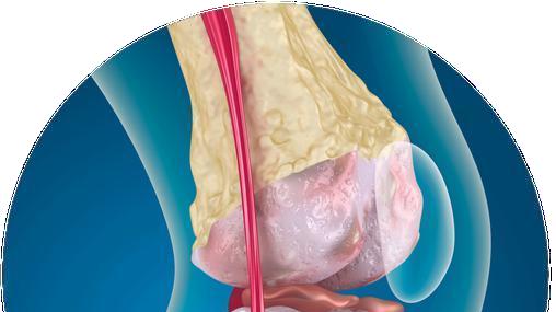 警惕！每5个HIV病毒感染者就有1人骨质疏松，这类人尤其危险