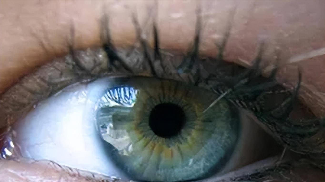 青光眼正在偷走你的视力，却浑然不知，40岁之后做好预防