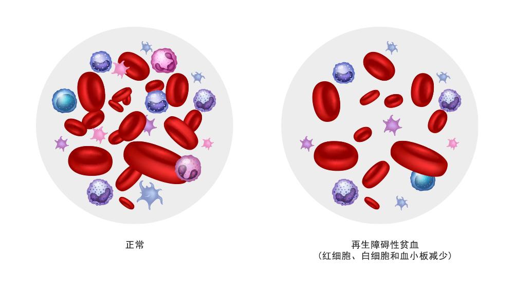 干细胞疗法Omisirge获FDA批准用于治疗重型再生障碍性贫血