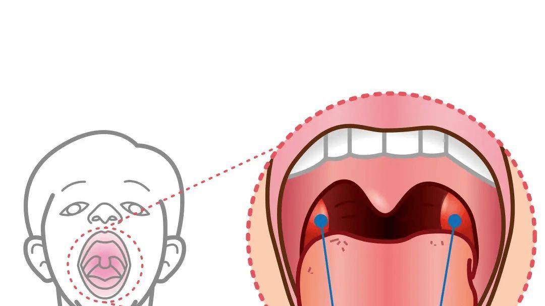 好好的扁桃体，怎么就那么容易发炎？