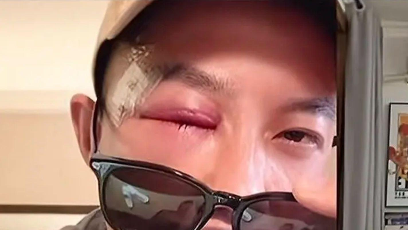 耳光大赛中被KO+陷入昏迷！中国武术大师颧骨骨裂缝5针 还要打5场