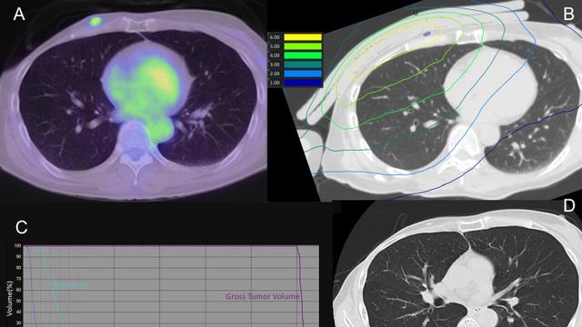 仅1-2次治疗，精准摧毁癌细胞！硼中子俘获疗法（BNCT）日本已批准，为头颈癌、乳腺癌患者提供新选择