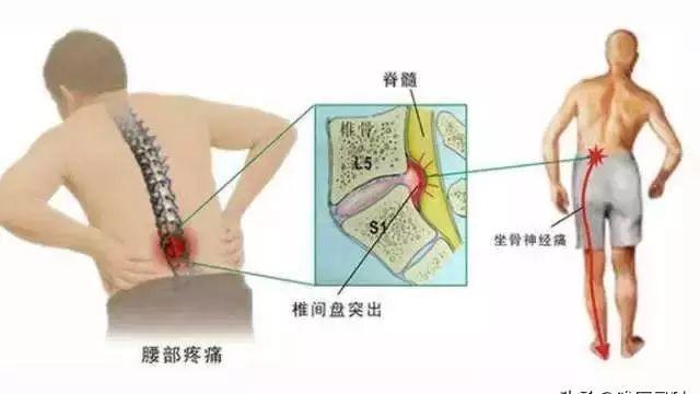 腰突患者最关心的 10 个问题：医生没说但你必须知道的真相