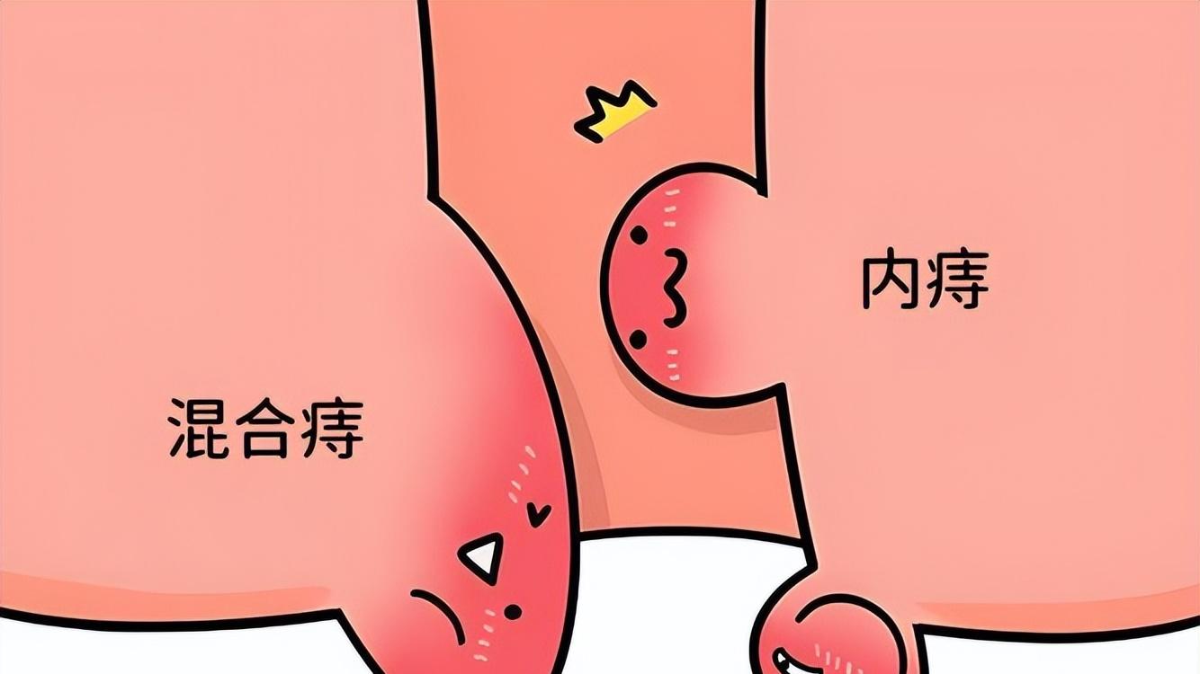 "菊"部问题别再忍了！6个习惯容易得痔疮，出现便血，及时就医