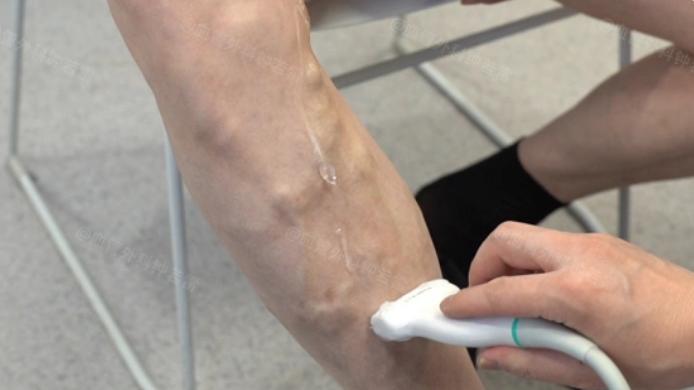 老人腿上青筋凸起，是老了正常还是静脉曲张？一篇文章教大家辨别