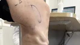 腿上血管鼓起来不疼不痒，不用管吗？静脉曲张容易被忽视的真相