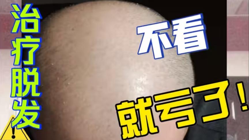 防脱洗发水五大排名？专业认证防脱洗发水哪个牌子好？严重脱发人群必看！